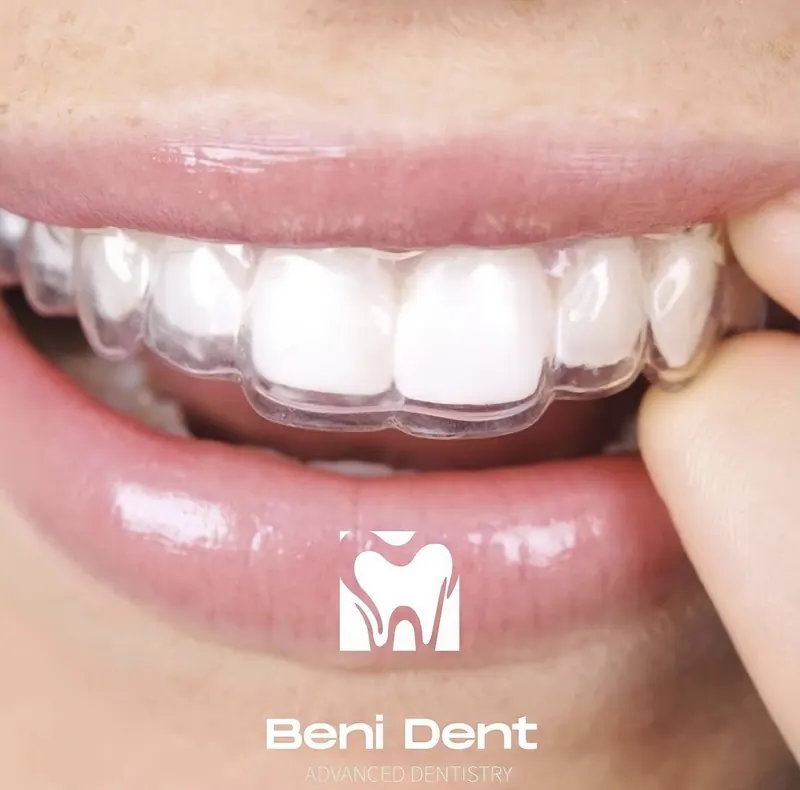 Smile with a clear aligner