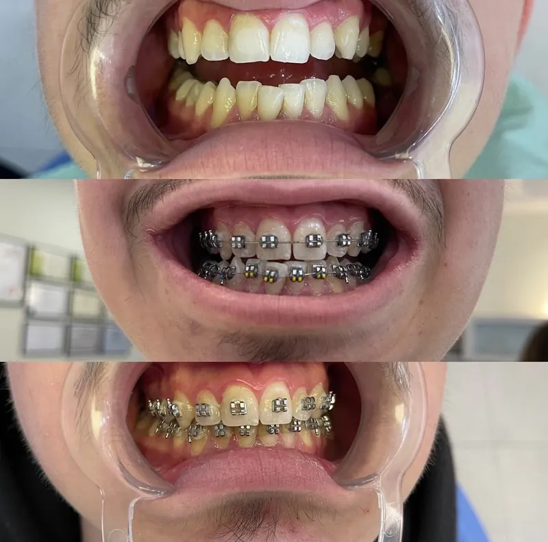Teeth with fixed braces, step by step