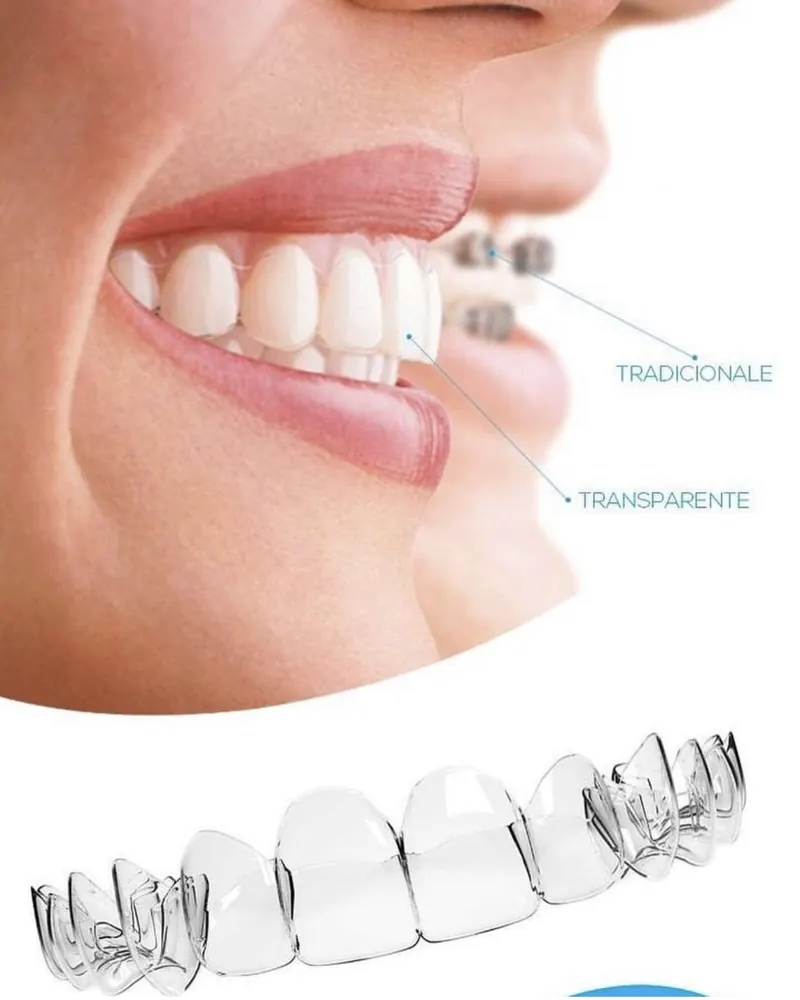Illustration comparing traditional braces and clear aligners