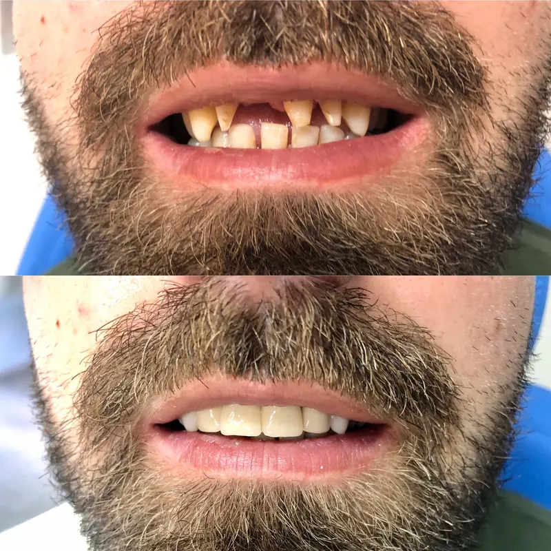Gaps between teeth before and after treatment