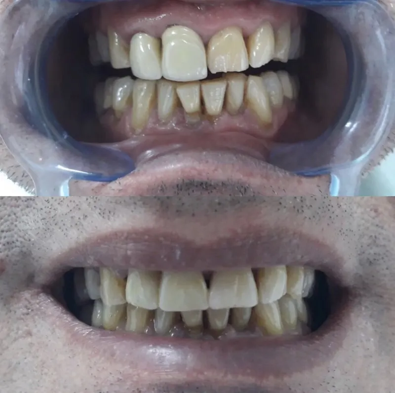 Front teeth before and after treatment, close-up