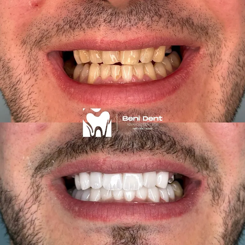 A brighter, even smile before and after