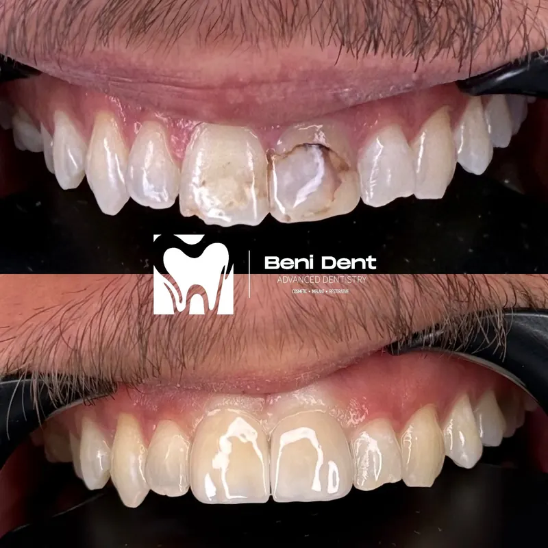 Front teeth before and after restoration
