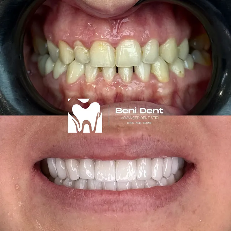Full smile makeover, before and after