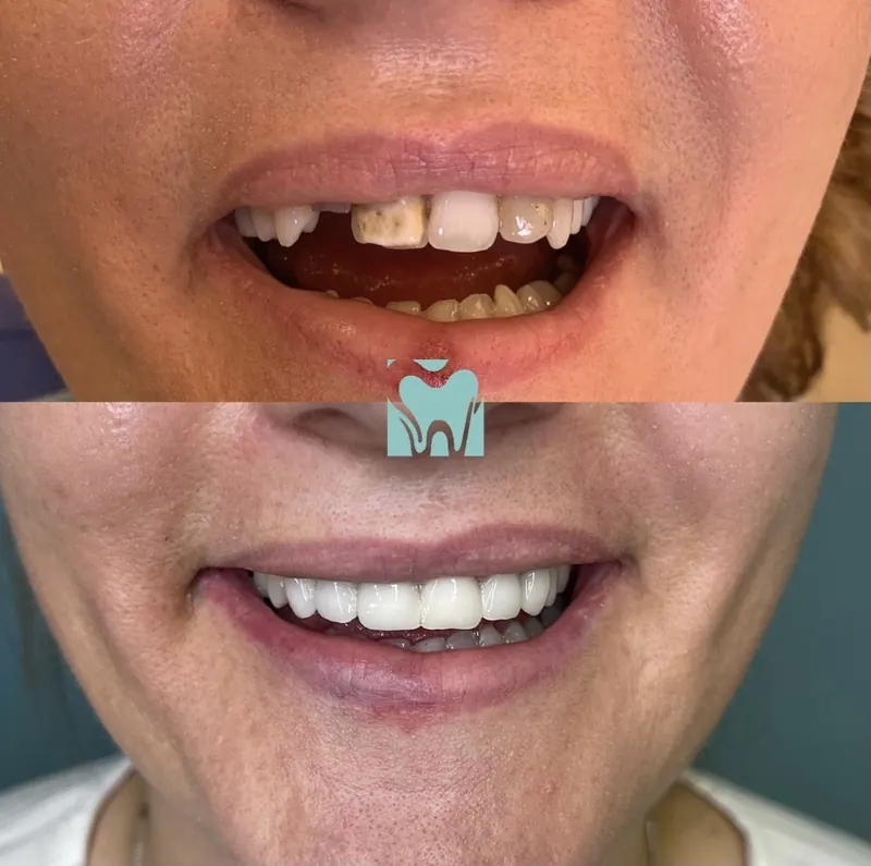 Missing front tooth before, complete smile after