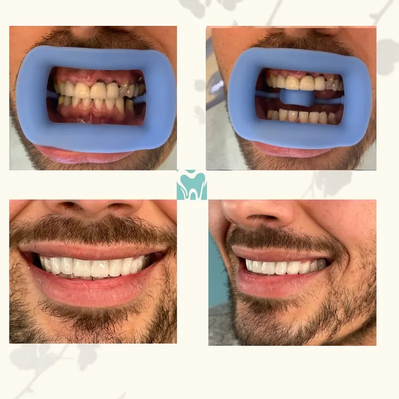 Smile before and after, front and side views