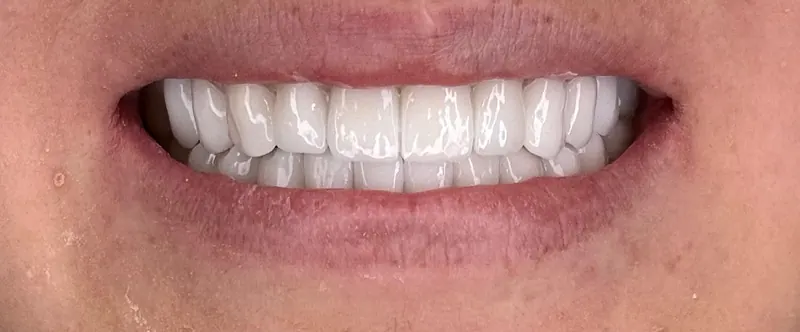 A finished smile after treatment